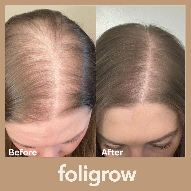 Foligrow Before and After