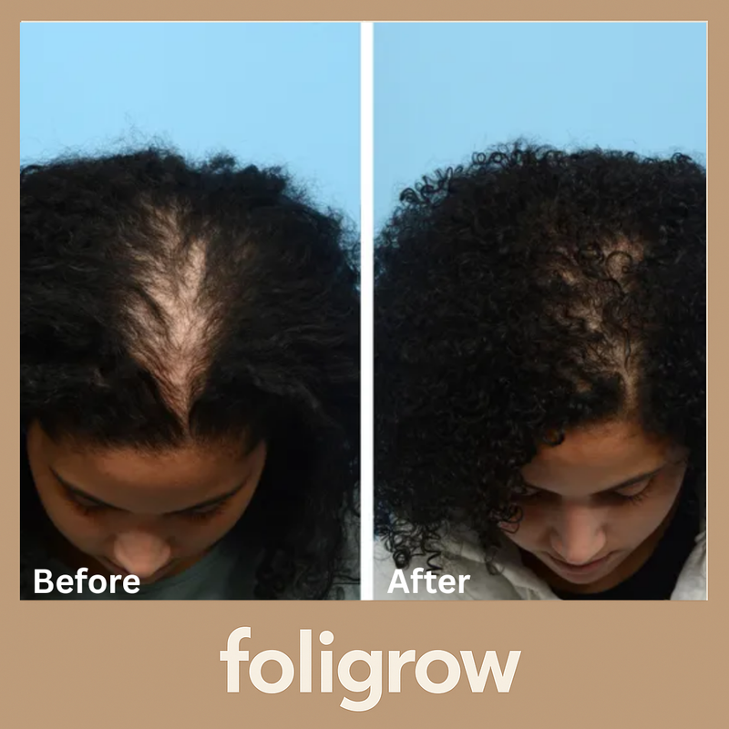 Foligrow Before and After